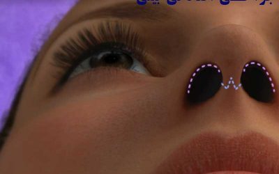 جراحی افتادگی بینی در اردبیل