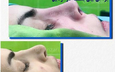 جراحی بینی به روش بسته در اردبیل