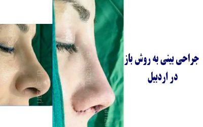 جراحی بینی به روش باز در اردبیل