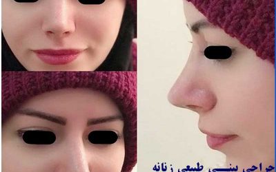 عمل بینی طبیعی زنانه در اردبیل