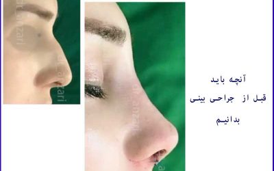 نکات طلایی که قبل و بعد از جراحی بینی باید بدانید