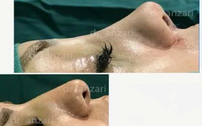 عمل بینی نیمه فانتزی در اردبیل