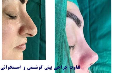 تفاوت جراحی بینی استخوانی و گوشتی