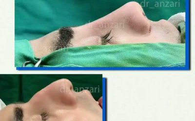 مدت زمان استفاده از تامپون در جراحی بینی