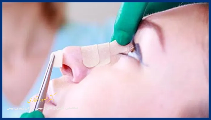 علت چسب زدن بینی بعد از عمل