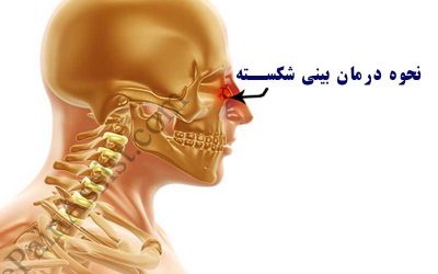 هزینه عمل بینی شکسته