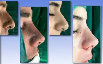 عمل بینی استخوانی بهتر است یا گوشتی