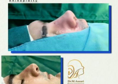 جراحی بینی دکتر انظاری در اردبیل