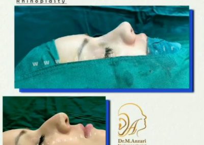 جراحی بینی دکتر انظاری در اردبیل