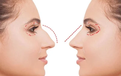 جراحی همزمان بینی و پلک همراه با فیلم و نمونه کار