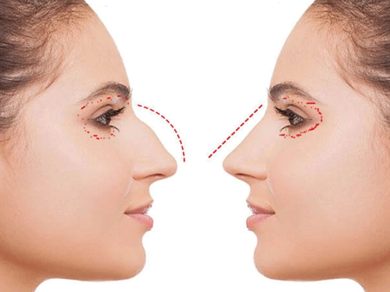 جراحی همزمان بینی و پلک همراه با فیلم و نمونه کار