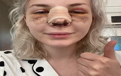 درمان قطعی کبودی دور چشم بعد از عمل بینی