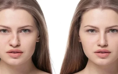 هزینه عمل بینی استخوانی در اردبیل سال 1404