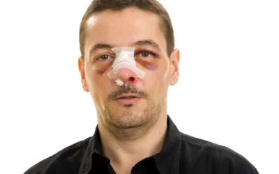 شکستگی بینی