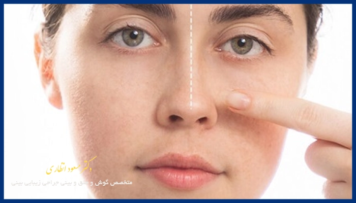 علت چرب شدن پوست بینی بعد ازعمل