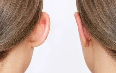 جراحی زیبایی گوش یا اتوپلاستی