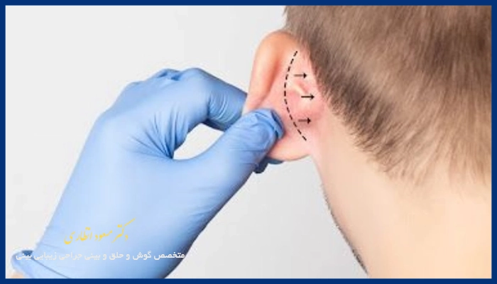 نکات مراقبتی بعد از جراحی اتوپلاستی را تا چه زمانی باید رعایت کرد؟