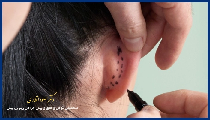 چرا سن در جراحی اتوپلاستی مهم است؟