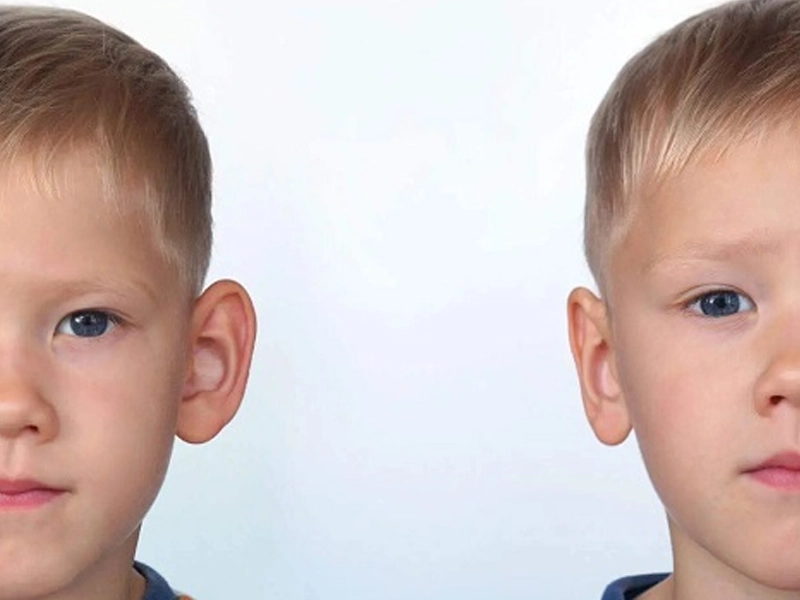 بهترین سن برای جراحی زیبایی گوش یا اتوپلاستی