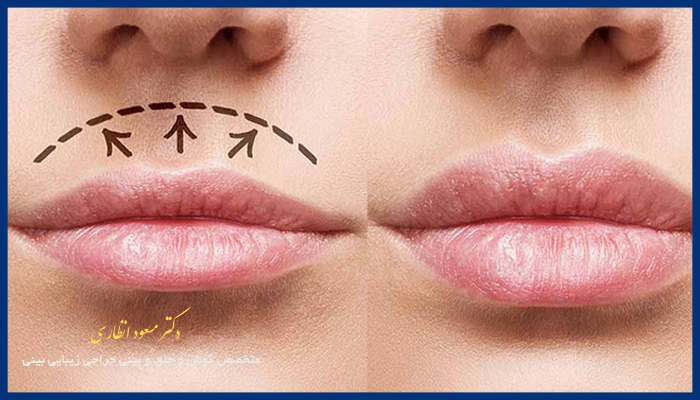 لیفت سانترال لب برای چه کسانی مناسب است؟