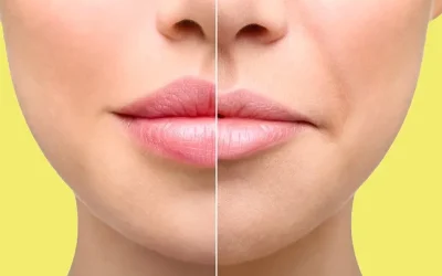 مراقبت‌های بعد از لیفت سانترال لب