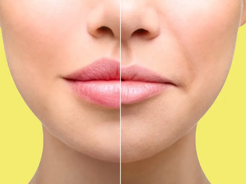 مراقبت‌های بعد از لیفت سانترال لب